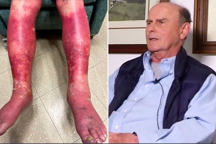 Man’s Skin Burns, Swells, Then Peels Off in Severe Reaction to Johnson & Johnson Covid Vaccine