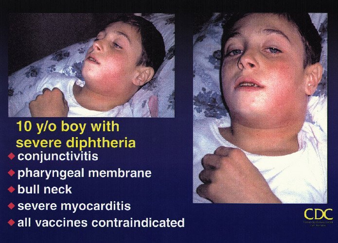 Diphtheria becomes major global threat again as it evolves antimicrobial resistance