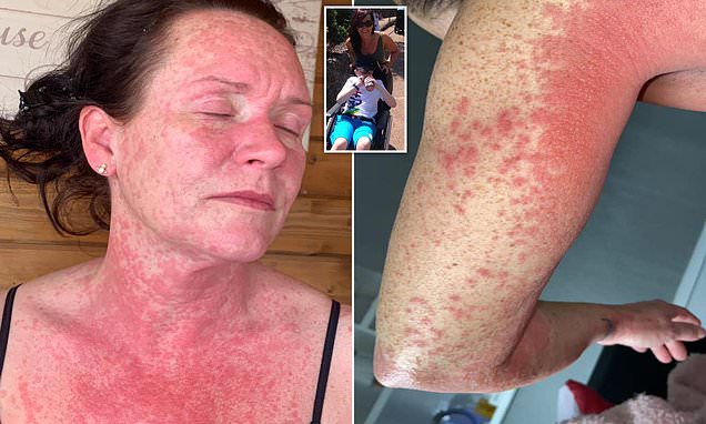 Mother's face, arms, chest, back and legs erupt in agonising red rash after getting AstraZeneca's Covid vaccine - as 41-year-old claims she is still in unbearable pain two weeks later