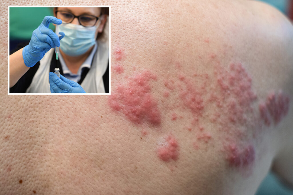 RASH HORROR Shingles could be new but rare side effect of Covid vaccine, docs discover