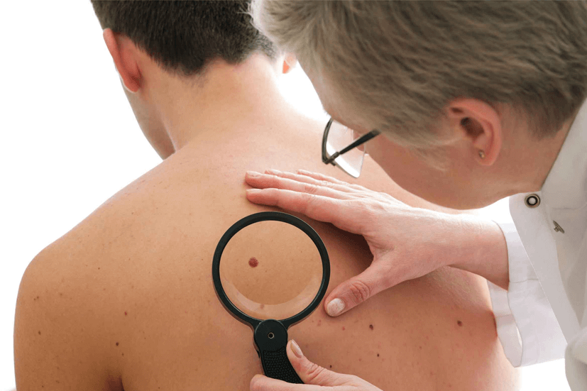 Itchy Mole – When You Need to Worry About Moles that Itch