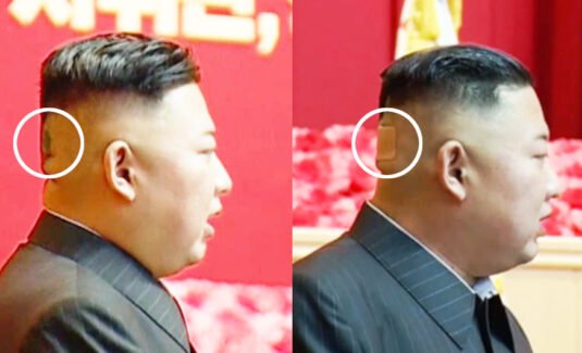 Mysterious spot and bandage appear on back of Kim Jong Un’s head