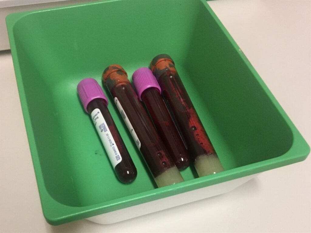 UK's health service is running out of blood test tubes – doctors say it could lead to 'catastrophe'