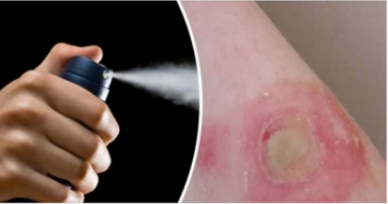Mother’s WARNING: Deodorant Challenge craze leaves her daughter with severe burns