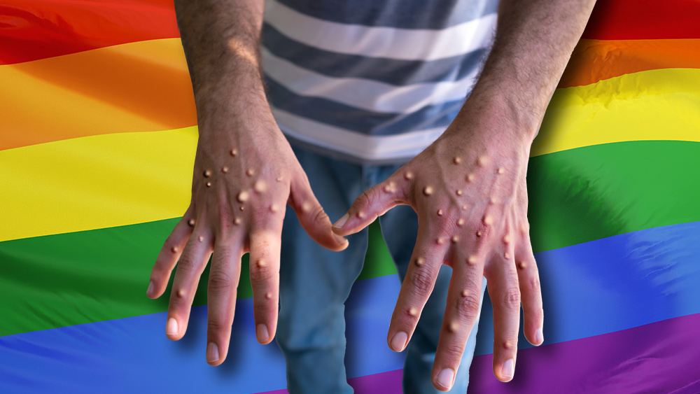 If gays didn’t receive special treatment by society, monkeypox would be a non-issue