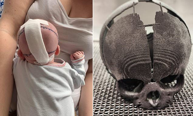 Baby given four days to live after being born with part of her SKULL missing has lifesaving surgery after doctors practiced on a 3D-printed replica of her head
