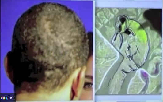 Head Scars Of Obama Match Akhenaten Hieroglyph! Pharaoh Returning For End Times