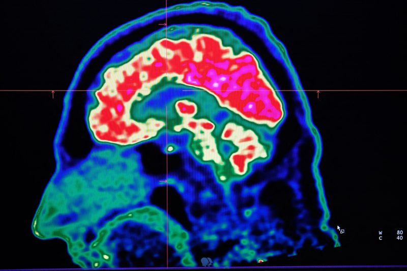 Researchers Discover Potential Parkinson’s Disease Treatment
