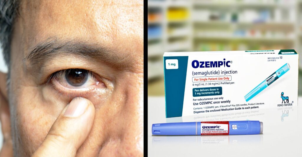 Study Links Ozempic to Blindness, Adding to Growing List of Side Effects